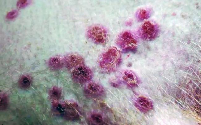 魁省最快周五接种疫苗 猴痘确诊病例增至25