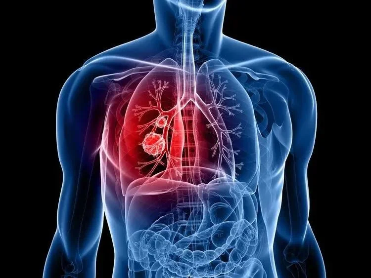 肺癌来临总是“不声不响” 警惕身体有这4个表现