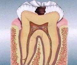 蛀牙不补的后果有多严重，你知道吗？