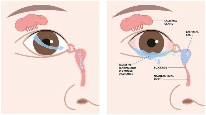 宝宝不哭闹也流眼泪？警惕先天性鼻泪管阻塞