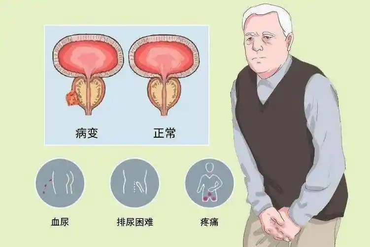 前列腺增生都有哪些症状？这个生活习惯要警惕