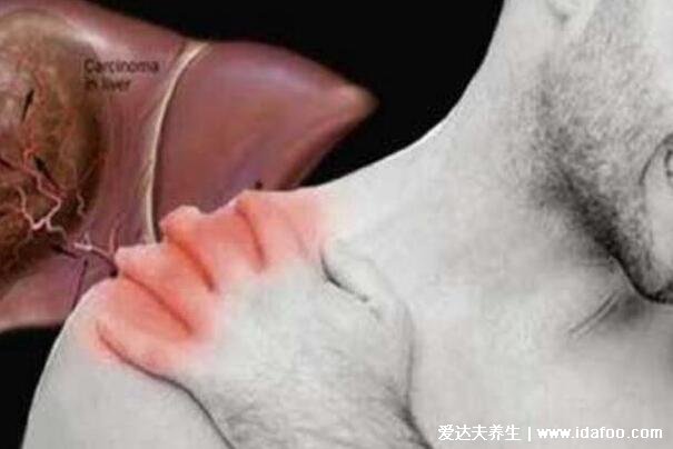 三个症状说明有肝癌了