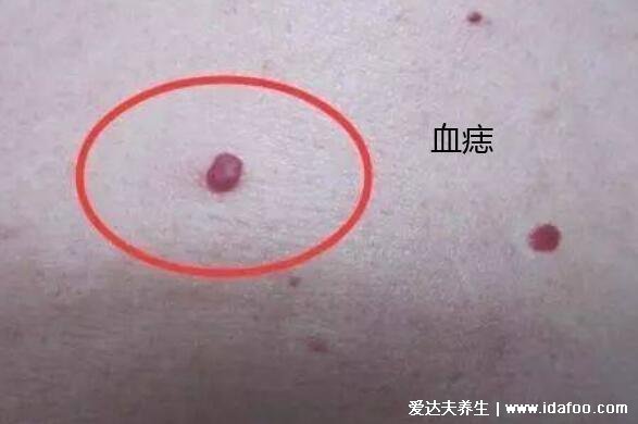 三个症状说明有肝癌了