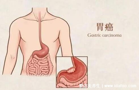女性胃癌早期有三处痛
