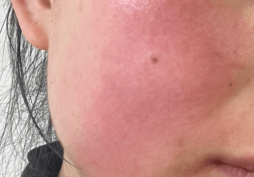 敏感肌的真相:不只是“皮肤薄”那么简单 敏感肌的真相:不只是“皮肤薄”那么简单