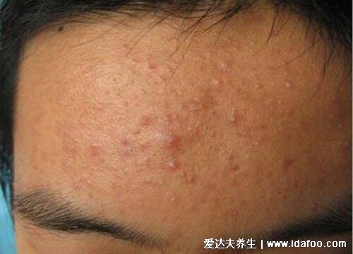 长痘痘的位置图解 长痘暗示身体出现了问题