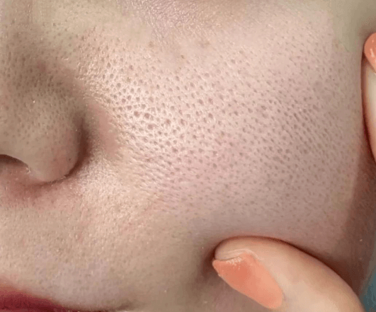 3分钟自测 帮你找准毛孔粗大问题根源