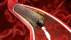 停止5类运动 很可能加速血栓形成 停止5类运动 很可能加速血栓形成