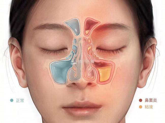 别误把鼻窦炎当感冒 5分钟精准分辨 别误把鼻窦炎当感冒 5分钟精准分辨