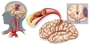 中国脑梗发病率世界第一!医生:3种蔬菜要少吃 中国脑梗发病率世界第一!医生:3种蔬菜要少吃