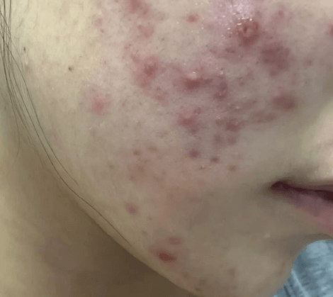 油性皮肤一直长痘痘怎么办? 油性皮肤一直长痘痘怎么办?