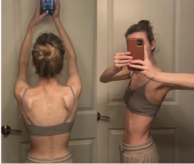 患罕见病几乎无法吃饭:女子自费到国外做手术 患罕见病几乎无法吃饭:女子自费到国外做手术