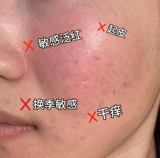 敏感泛红紧急“灭火” 4步稳住肌肤告别红苹果脸 敏感泛红紧急“灭火” 4步稳住肌肤告别红苹果脸