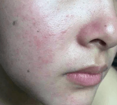 脸反复过敏+屏障受损？别乱涂药膏