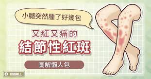 腿上突然长“硬包”?可能不是蚊子咬 腿上突然长“硬包”?可能不是蚊子咬