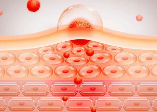 别把过敏当缺水 皮肤过敏的6大典型症状