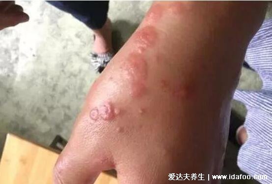 一个月不发烧排除艾滋病 不准确潜伏期可达15年