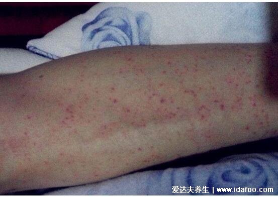 ��ͯ��Ѫ������Ѫ�ص� ����ֹס��Ѫ����