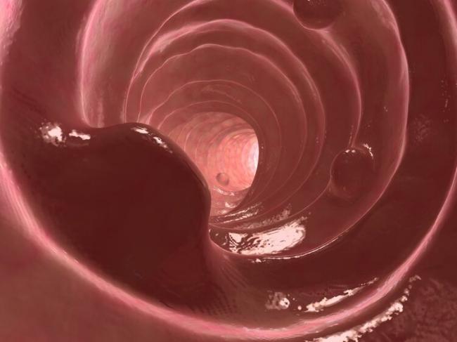 超80%的肠癌由息肉恶变而来 留意这些排便症状 超80%的肠癌由息肉恶变而来 留意这些排便症状