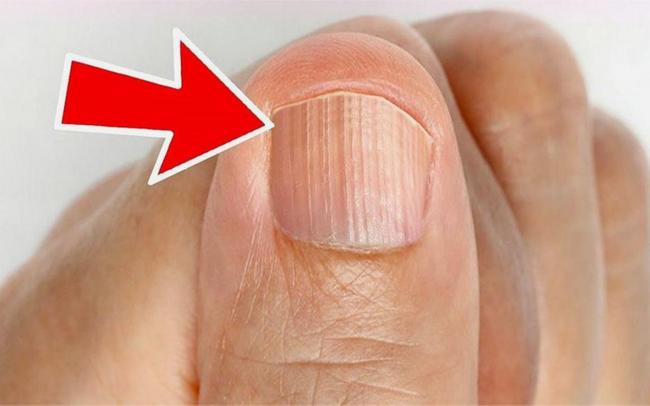 指甲长竖纹是健康“警报”？看有没有这4个特征