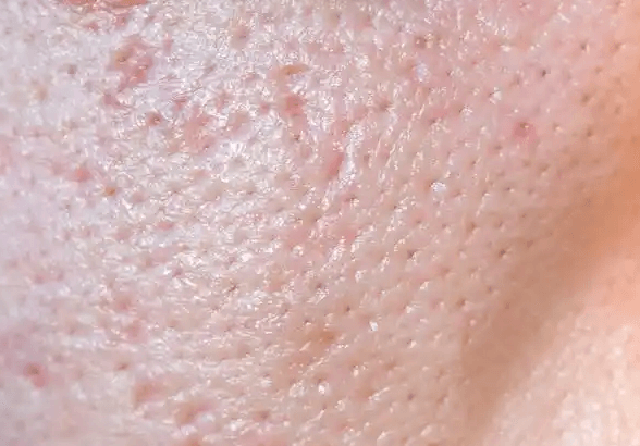 毛孔粗大别乱治先搞懂3大成因 4个方法精准改善 毛孔粗大别乱治先搞懂3大成因 4个方法精准改善