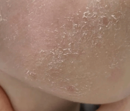 皮肤缺水会长痘痘吗？答案颠覆认知