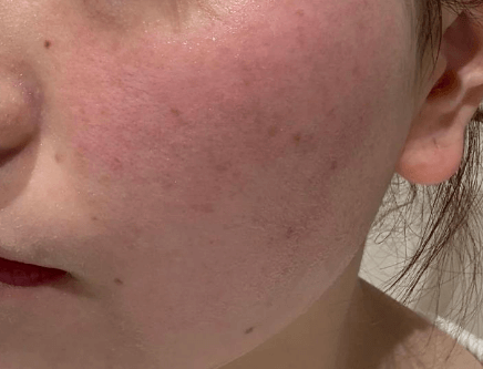 冬季敏感肌8大注意事项 安稳度过干燥季