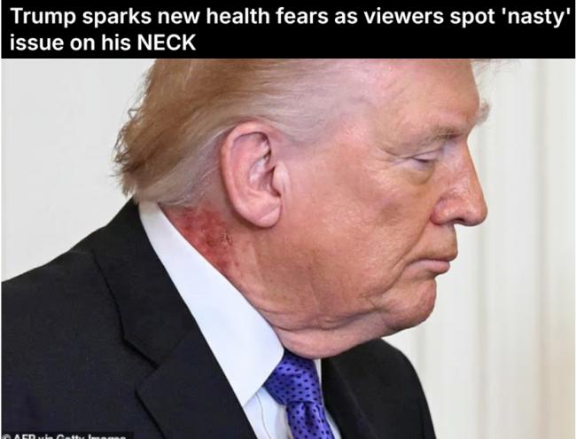 川普颈部惊现大片红斑, 伊朗开战后健康恶化?