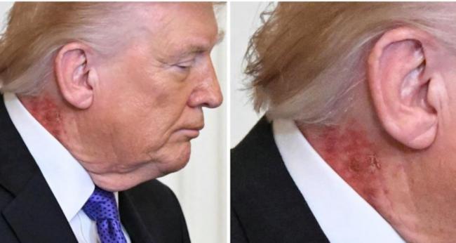 川普颈部惊现大片红斑, 伊朗开战后健康恶化?