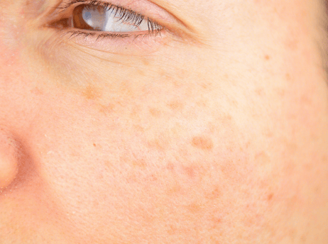 抓住春季护肤窗口期 轻松应对干燥和色斑