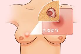 乳腺结节会变成癌吗？医生：这3种情况要注意