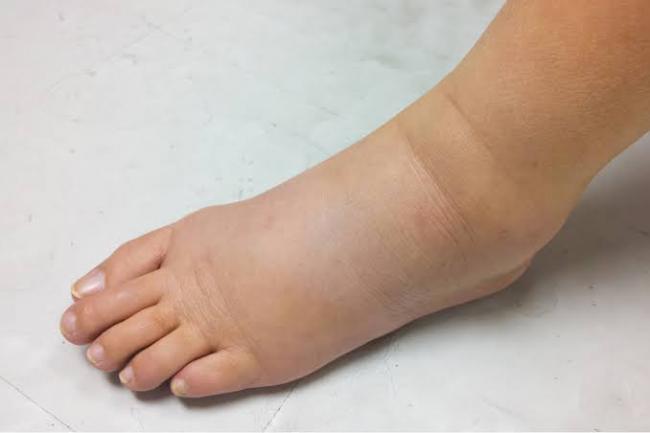脚肿是肾有问题？四种情况别忽视